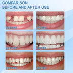 Close-up view of the cosmetic dental veneer and tooth-shaped finish