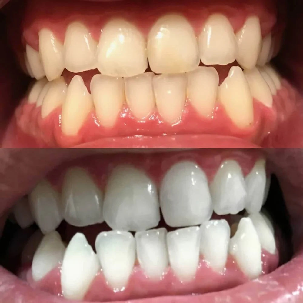 Portable whitening pen for everyday smile care