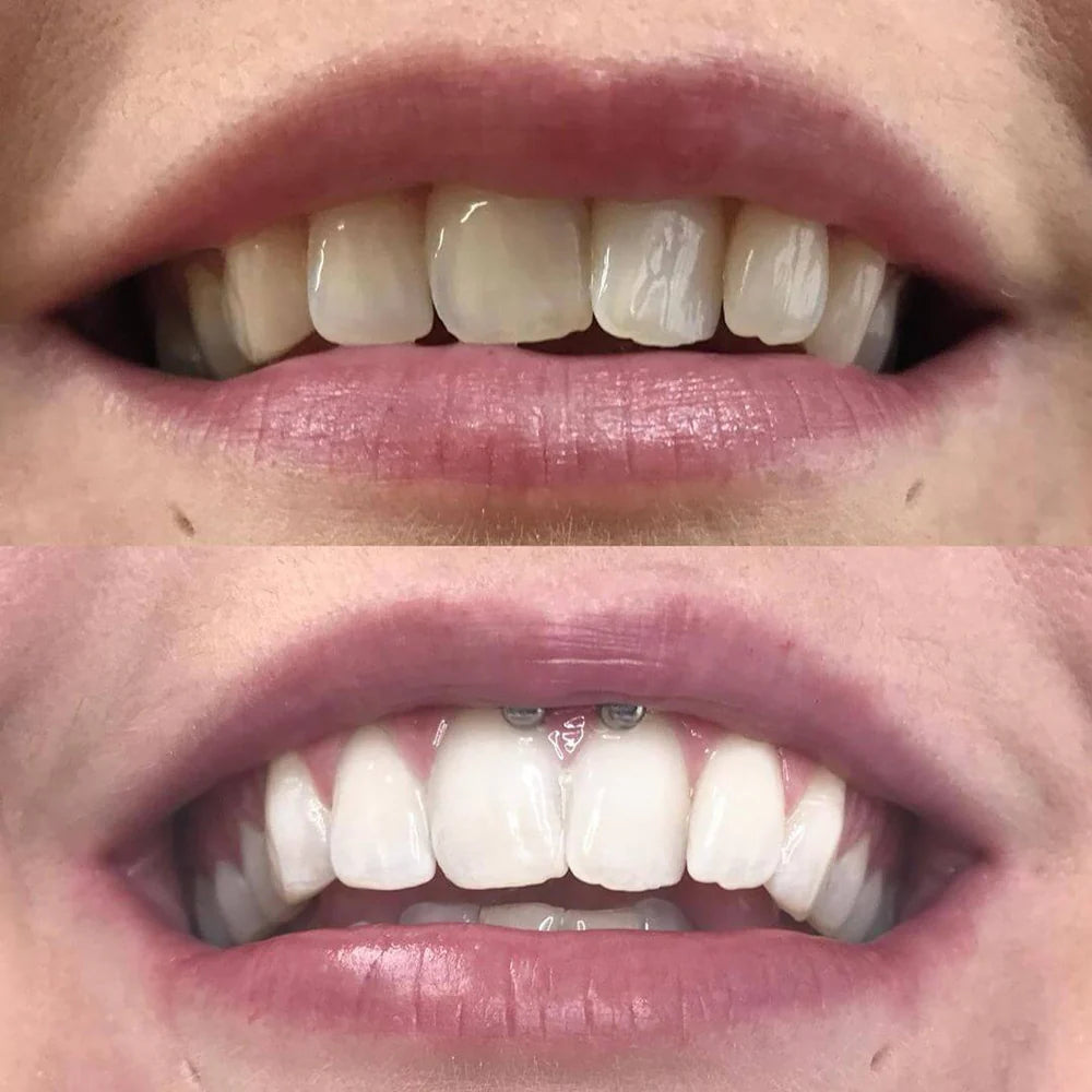 Teeth whitening pen shown ready for smile care