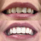 Teeth whitening pen shown ready for smile care