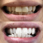 At-home teeth whitening pen for a brighter-looking smile