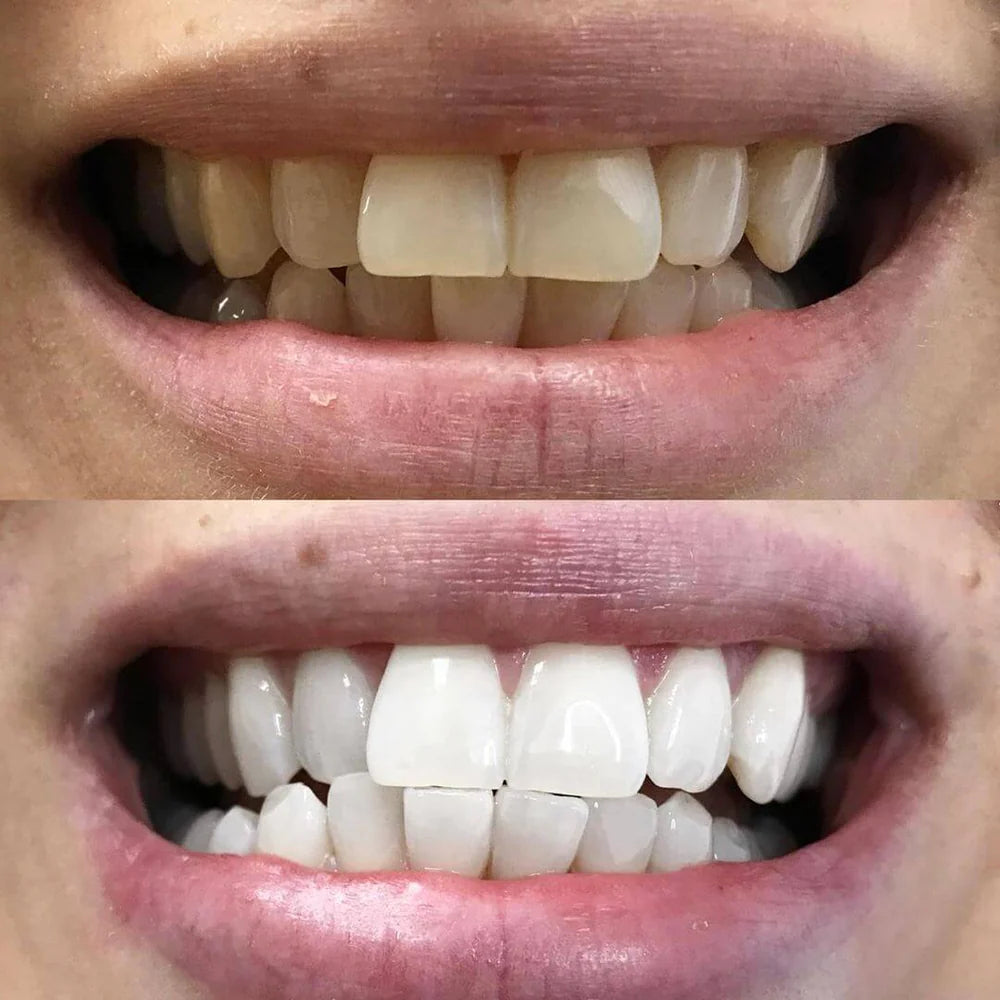 At-home teeth whitening pen for a brighter-looking smile